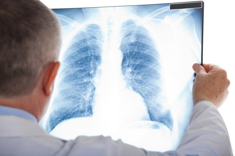 Lao phổi cũng là bệnh hết sức nguy hiểm.