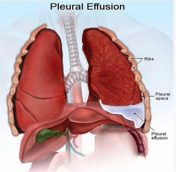 Có nhiều nguyên nhân gây ra bệnh tràn dịch màng phổi.
