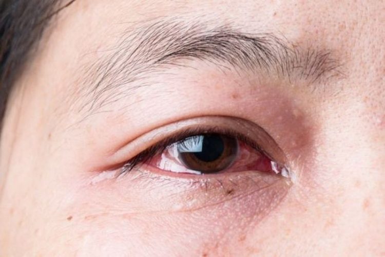 Có nhiều nguyên nhân gây ra viêm mống mắt.