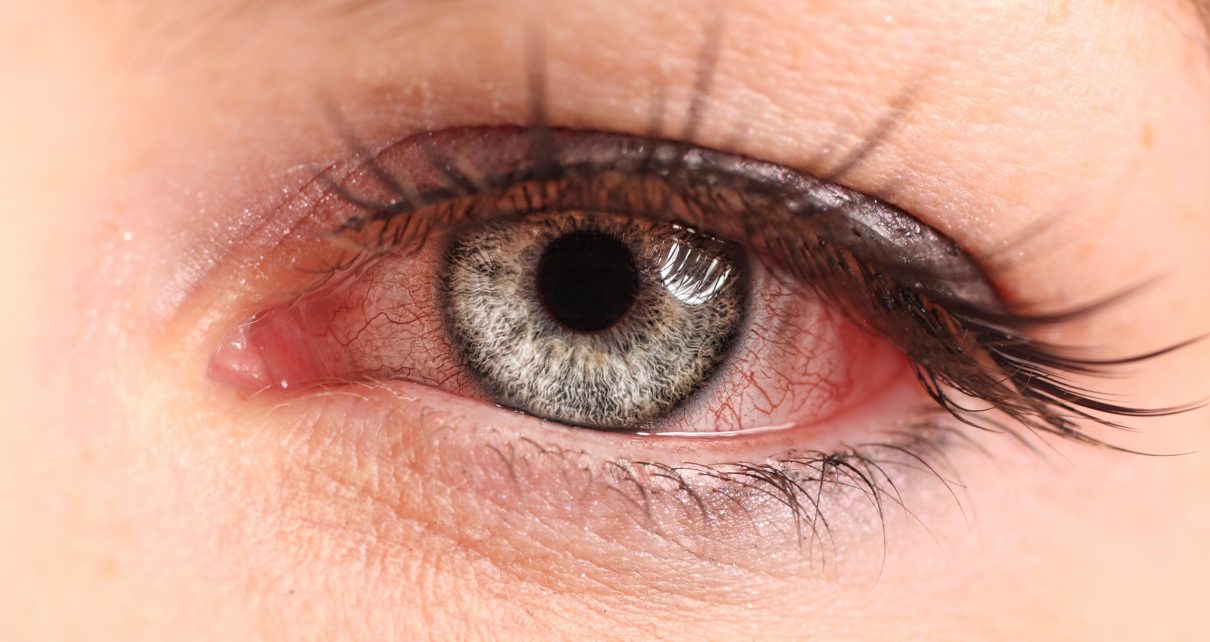 Tìm hiểu về viêm mống mắt và cách phòng bệnh