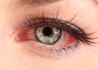 Tìm hiểu về viêm mống mắt và cách phòng bệnh